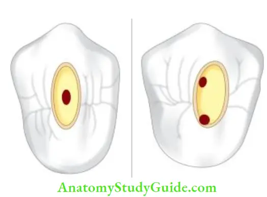 Access Cavity Preparation Occlusal view of access cavity shape of maxillary second premolar with one and two canals.