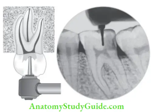 Access Cavity Preparation Preoperative radiograph can help to note the position and depth of pulp chamber.