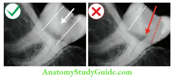 Access Cavity Preparation Proper- angulation of bur according to tilted crown; Perforation if bur is misdirected.