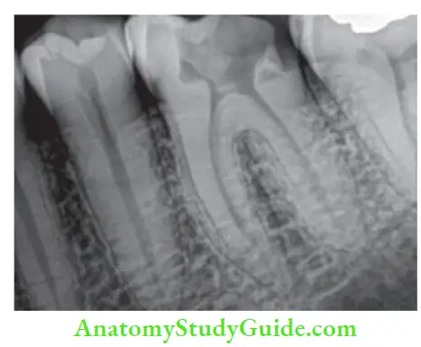 Access Cavity Preparation Radiograph helps to know morphology of teeth.