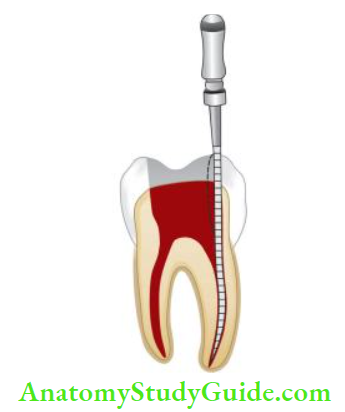 Access Cavity Preparation Removal of dentin interference from access opening gives straight line access to the canal without any undue bending.