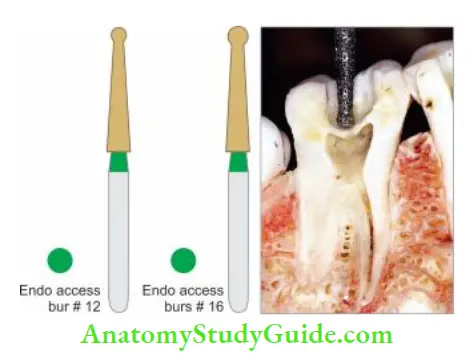 Access Cavity Preparation Round bur is used to gain entry into the tooth structure.