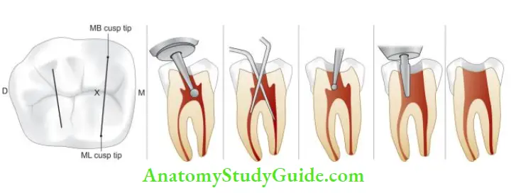 Access Cavity Preparation access cavity preparation for mandibular molars
