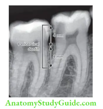 Access Cavity Preparation pericervial dentin 4 mm above and below the crestal bone.