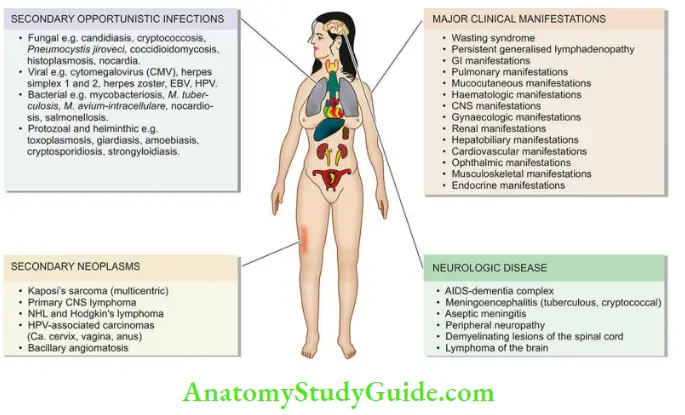 Acquired Immunodeficiency Syndrome Symptoms And Causes Major Pathological Lesions