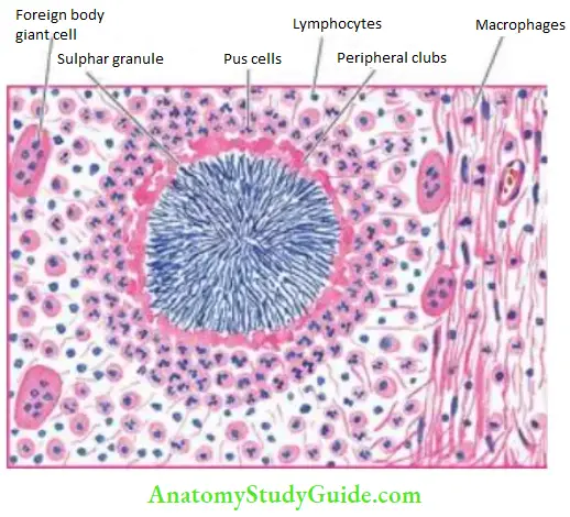 Actinomycosis Etiology Clinical Features Actinomycosis