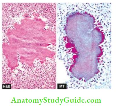 Actinomycosis Etiology Clinical Features Actinomycosis Masson’s Trichrome (MT) Stain