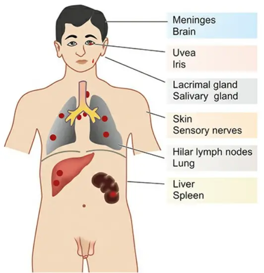 Actinomycosis Etiology Clinical Features Common Locations Of Lesions in Sarcoidosis