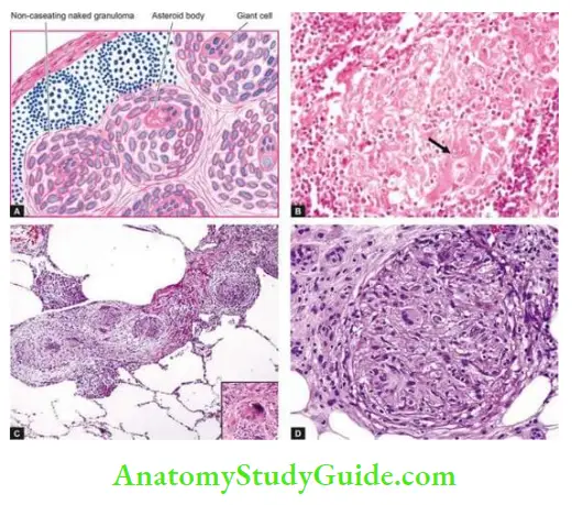 Actinomycosis Etiology Clinical Features Sarcoidosis at Common body Sites