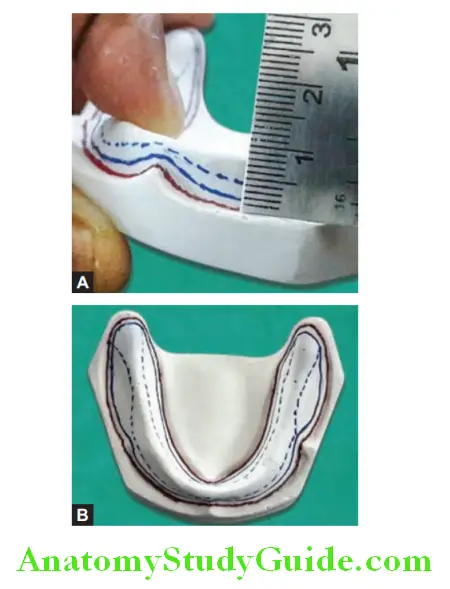 Adaptation Of Spacer On Primary Cast all guidelines draw on mandibular cast