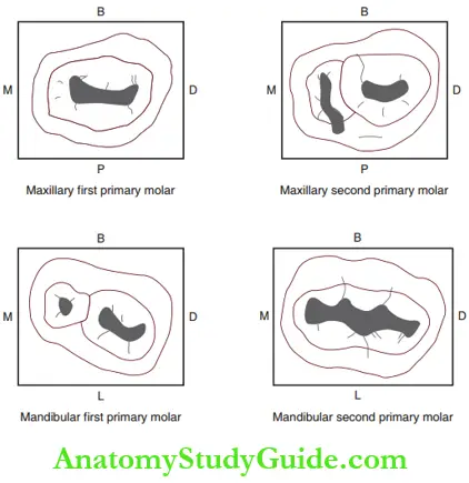 Amalgam Restorations On Primary Teeth Outline Form Of Class 1 Amalgam Restoration.B, Buccal Aspect; M, mesial aspect; D, distal aspect; P, palatal aspect; L, lingual aspect