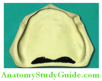 Anatomical Landmarks Edentulous Maxillary Arch posterior palatal seal area