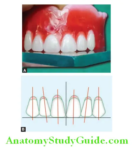 Arrangement Of Artificial Teeth all maxillary anterior teeth arranged in position
