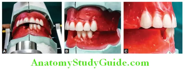 Arrangement Of Artificial Teeth arrangement of mandibular anterior