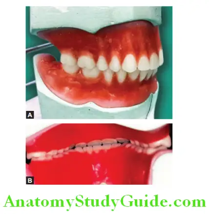 Arrangement Of Artificial Teeth complete arrangement of maxillary and mandibular teeth buccal ligual view