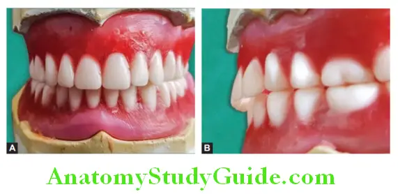 Arrangement Of Artificial Teeth complete arrangement of nonanatomical posterior teeth