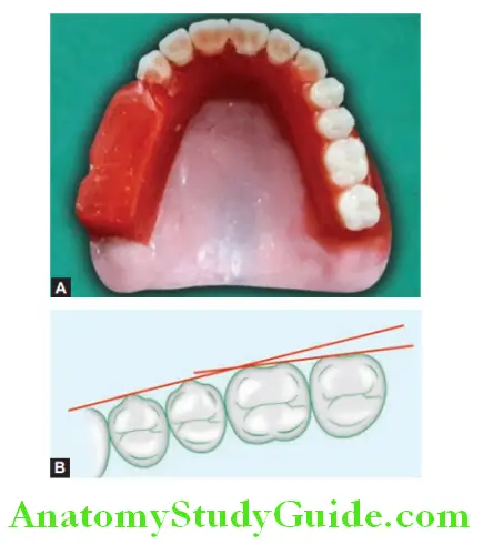 Arrangement Of Artificial Teeth four posterior teeth arranged in one line