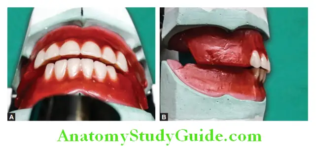 Arrangement Of Artificial Teeth horizontal overlap is 1-2 mm and vertical overlap is 0.5-1