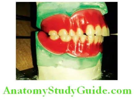 Arrangement Of Artificial Teeth increased overjet in class II arragnement