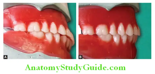 Arrangement Of Artificial Teeth mandibular first molar in occlusion with maxillary first molar and second premolar