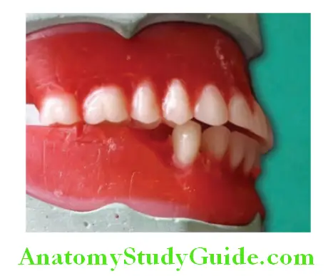 Arrangement Of Artificial Teeth mandibular first premolar in occlusal with maxillary teeth