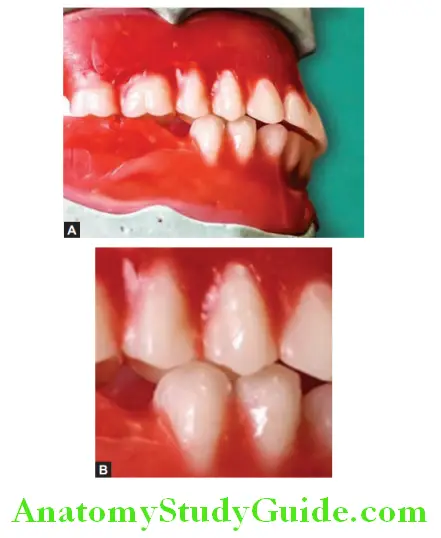 Arrangement Of Artificial Teeth mandibular second premolar in occlusion
