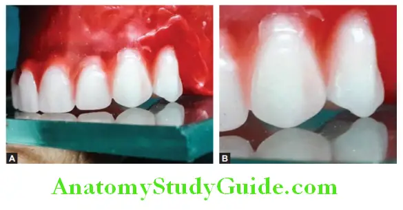 Arrangement Of Artificial Teeth maxillary first premolar in occlusal relation see the palatal cusp is not in contact with glass plate