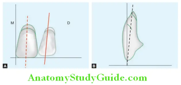 Arrangement Of Artificial Teeth maxillary lateral incisor frontal view and side view