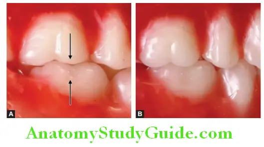 Arrangement Of Artificial Teeth molar key of occlusion posterior key occlusion