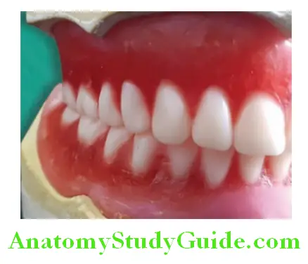 Arrangement Of Artificial Teeth no compensating curve given for posterior teeth arrangement