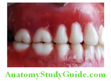 Arrangement Of Artificial Teeth no cusp to fossa relation between opposite teeth