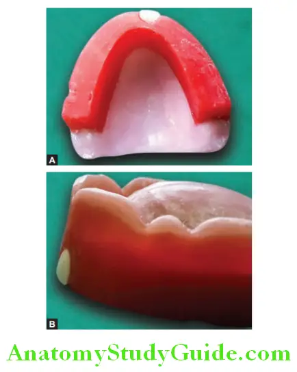 Arrangement Of Artificial Teeth placement of central incisor occlusal view and side view