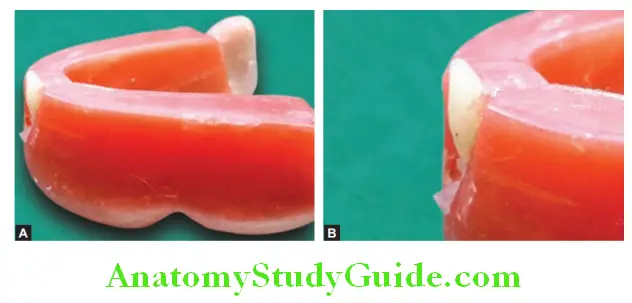 Arrangement Of Artificial Teeth placement of mandibular central incior side view