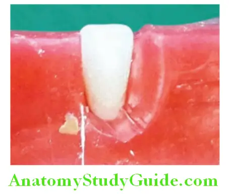 Arrangement Of Artificial Teeth placement of mandibular central incisor front view