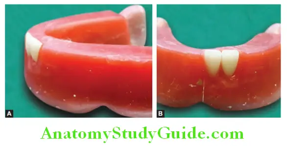 Arrangement Of Artificial Teeth placement of mandibular lateral incisor side view and front view