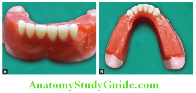 Arrangement Of Artificial Teeth removal of excess wax from lingual surface