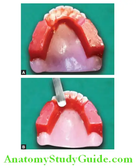 Arrangement Of Artificial Teeth removal of excess wax from palatal surface after teeth arranged in position