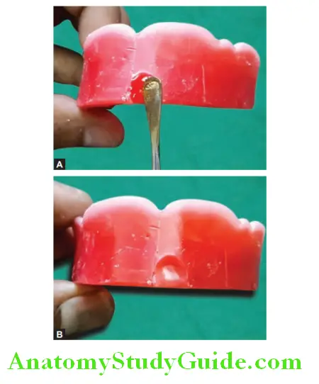 Arrangement Of Artificial Teeth scooping out the modeling wax in centeral incisor area