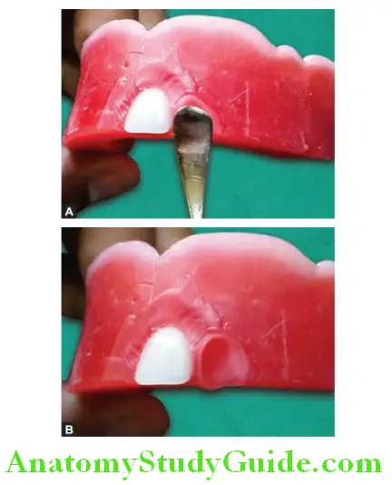 Arrangement Of Artificial Teeth scooping out the modeling wax in lateral incisor area