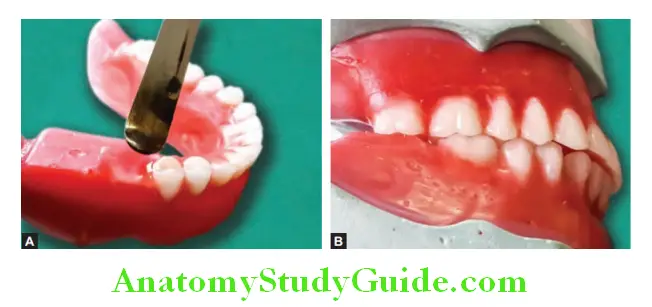 Arrangement Of Artificial Teeth scooping out the wax and placement of mandibular first molar