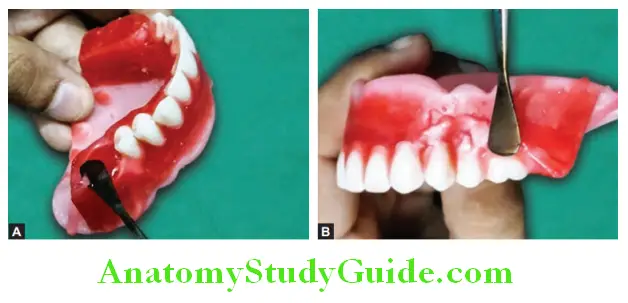 Arrangement Of Artificial Teeth scooping out the wax and placement of maxillary first molar