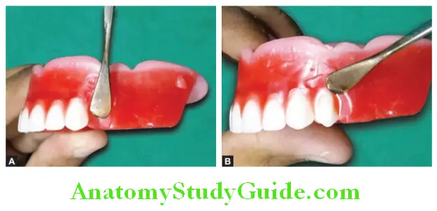 Arrangement Of Artificial Teeth scooping out the wax and placement of maxillary first premolar