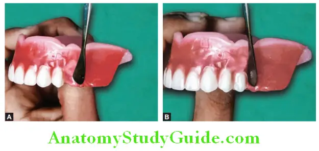 Arrangement Of Artificial Teeth scooping out the wax and placement of maxillary second premolar