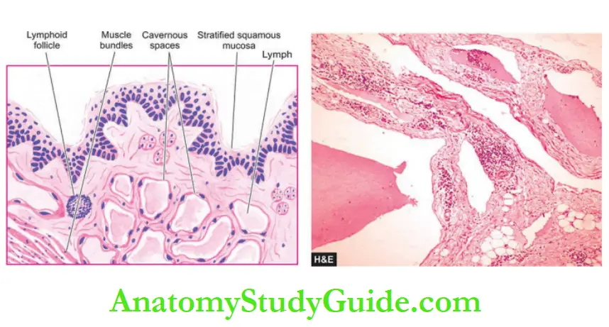 Blood Vessels And Lymphatics Cavernous lymphangioma in the soft tissues