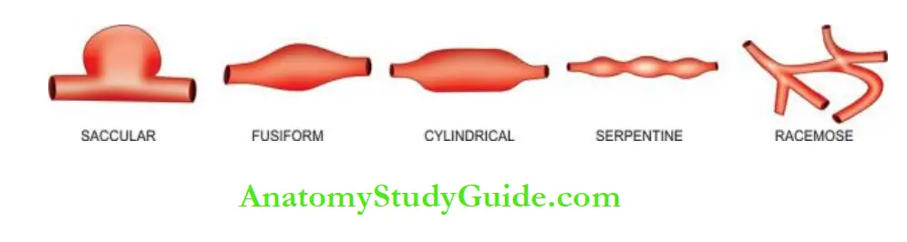 Blood Vessels And Lymphatics Common shapes of aneurysms of various types.