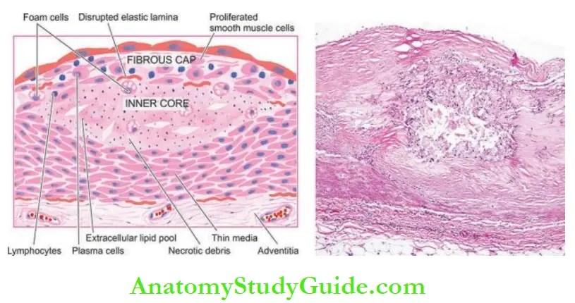 Blood Vessels And Lymphatics Histologic appearance of a fully-developed atheroma in the intimal layer