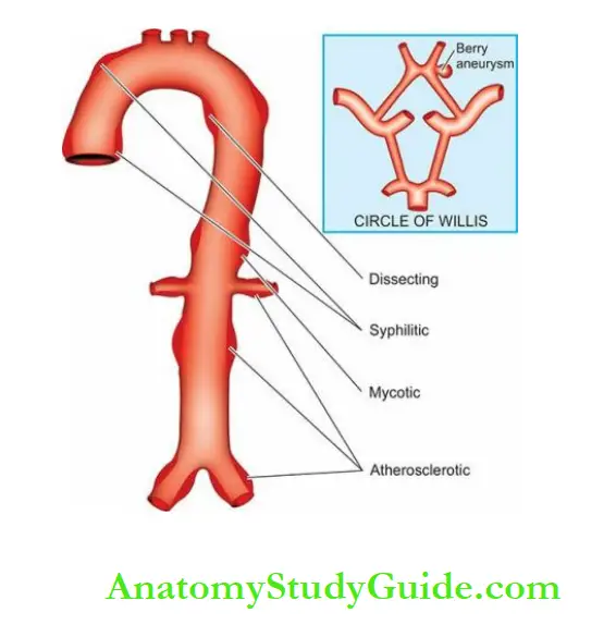 Blood Vessels And Lymphatics Sites of major forms of aneurysms.