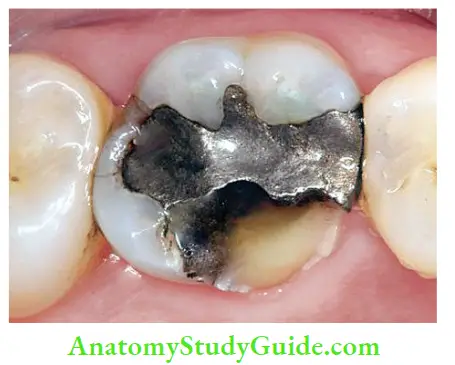 Case Selection And Treatment Planning Endodontic treatment and full coverage crown is indicated to manage fractured restoration of mandibular fist molar.