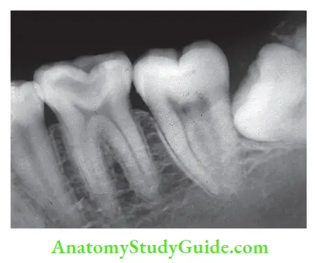 Case Selection And Treatment Planning Endodontic treatment is required to manage mandibular fist molar with deep dental caries.