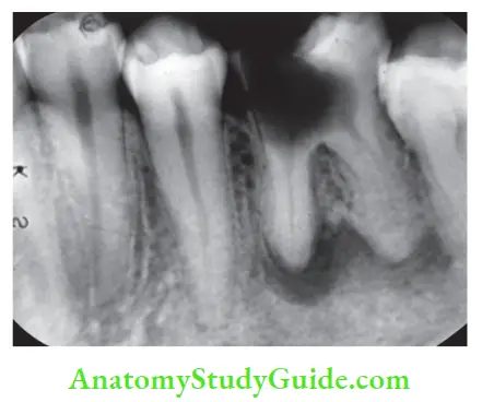 Case Selection And Treatment Planning Mandibular fist molar with extensive caries and periapical radiolucency is poor candidate for endodontic treatment.